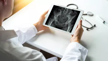 Resurfaçage de hanche : une prothèse de hanche moins invasive